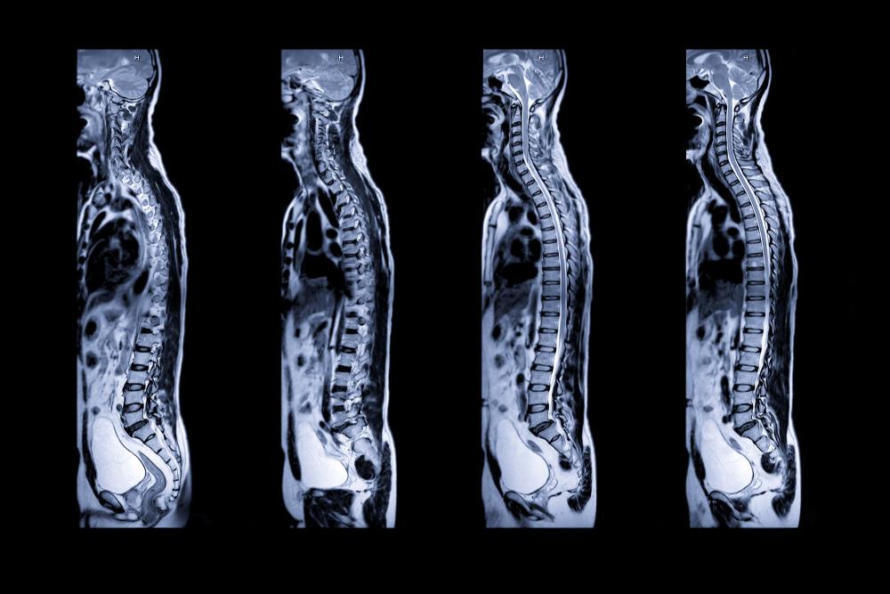 X-rays displaying a series of images of the human spine from different angles for medical analysis.